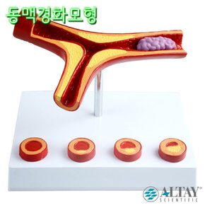 ALTAY Scientific 4단계 동맥경화 혈전증 CA4 10배확대 혈관모형