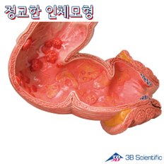 3B Scientific 인체모형 장질환모형 K55 결장과 직장사이의 각종 변병표현