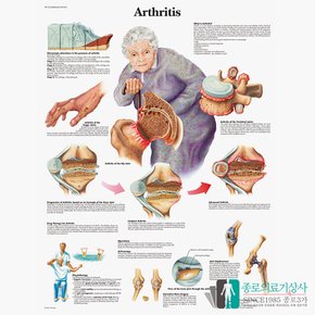 3B Scientific 관절 염 인체해부차트 VR1123 Arthritis 관절 염차트 병원액자