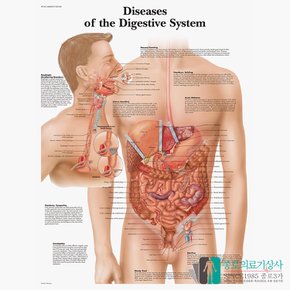 3B Scientific 소화기질병 인체해부차트 VR1431 소화계질환 병원액자