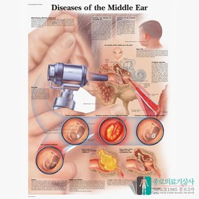 3B Scientific 중이염 인체해부차트 VR1252 중이염의이해 병원액자